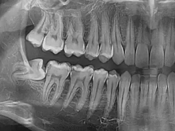 وضعیت اسفناک دندون عقلم